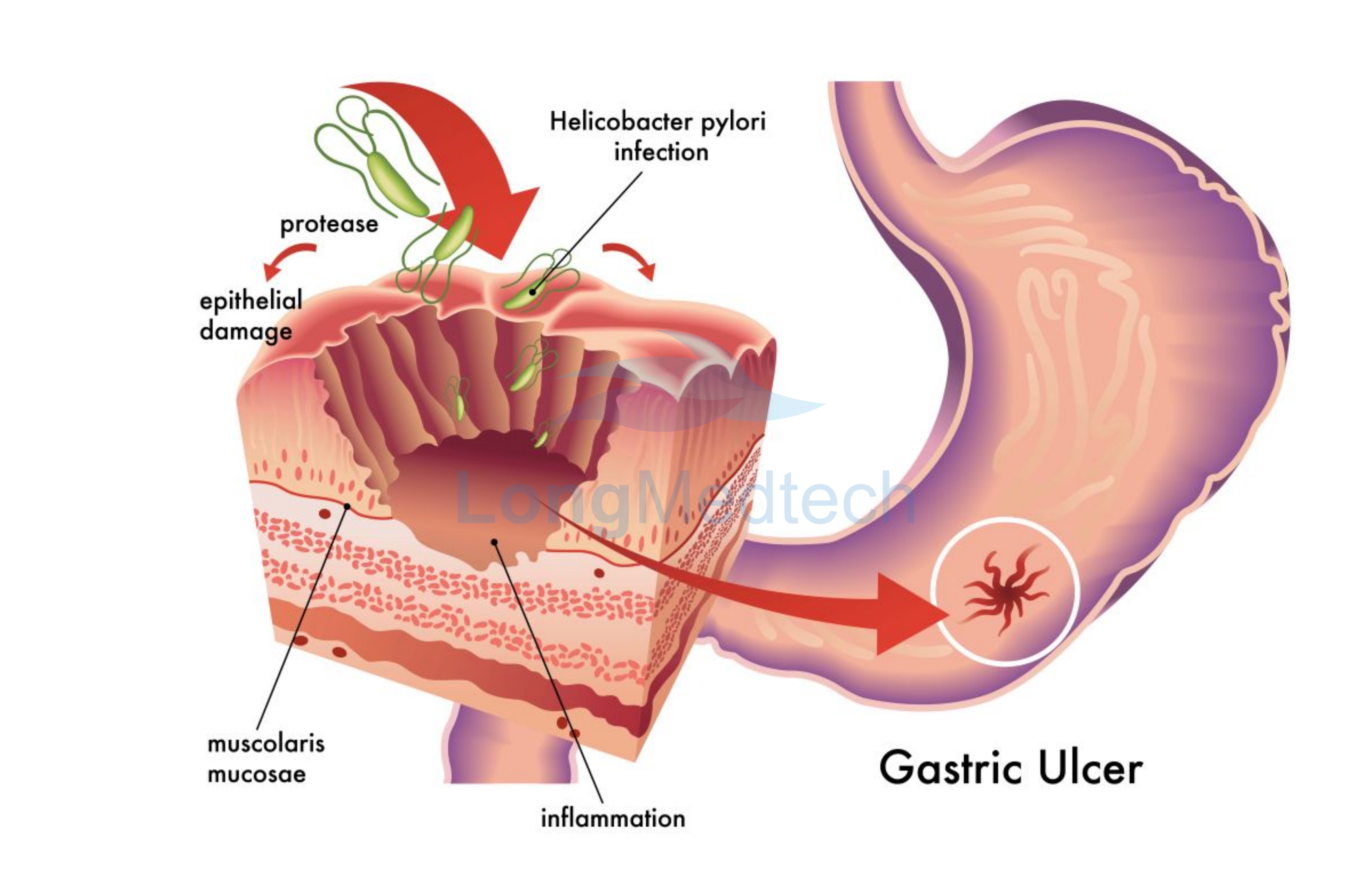 Helicobacter pylori Infection