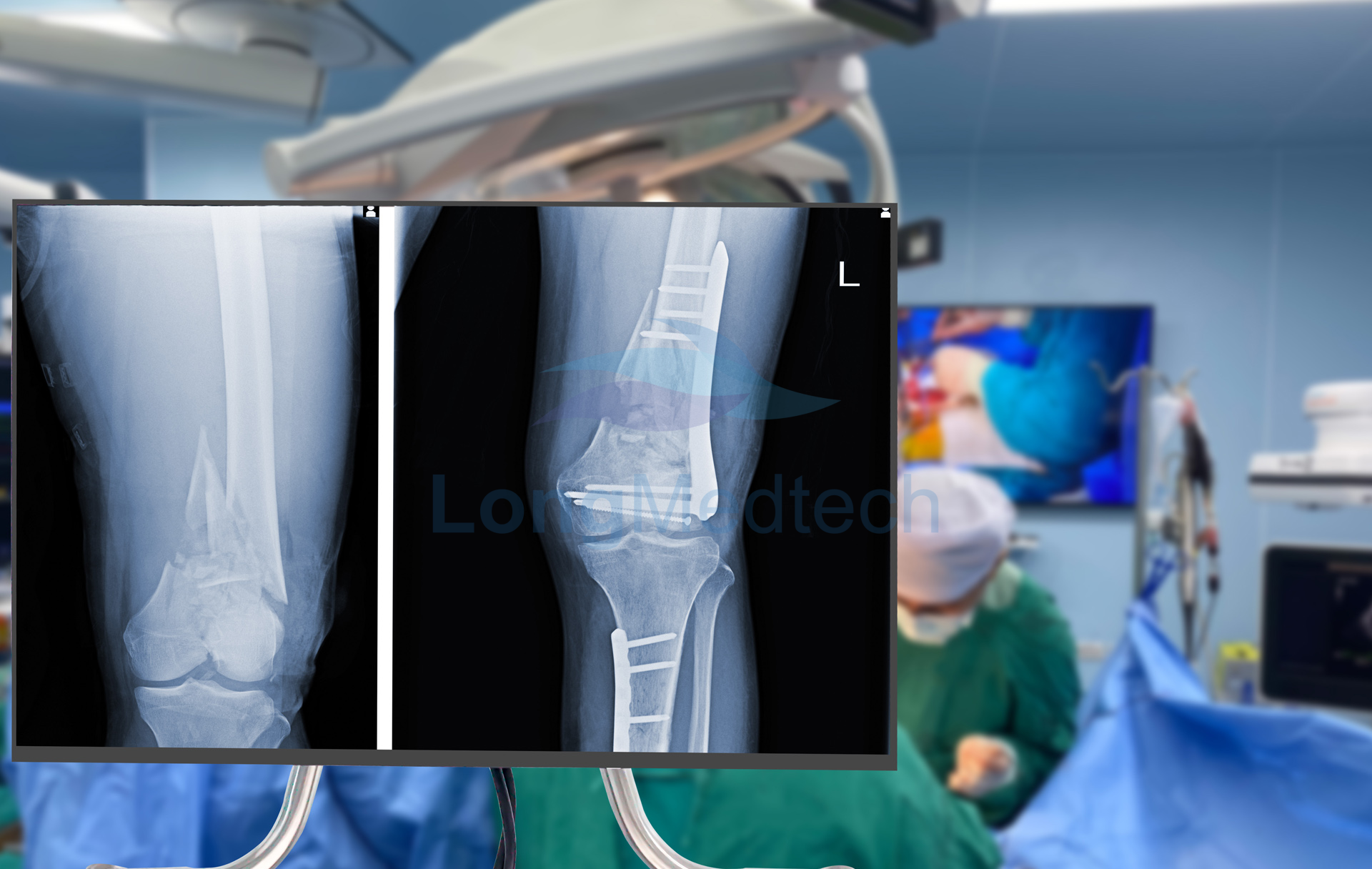 From Tubes To Panels: The Shift To Flat Panel Detectors in Imaging