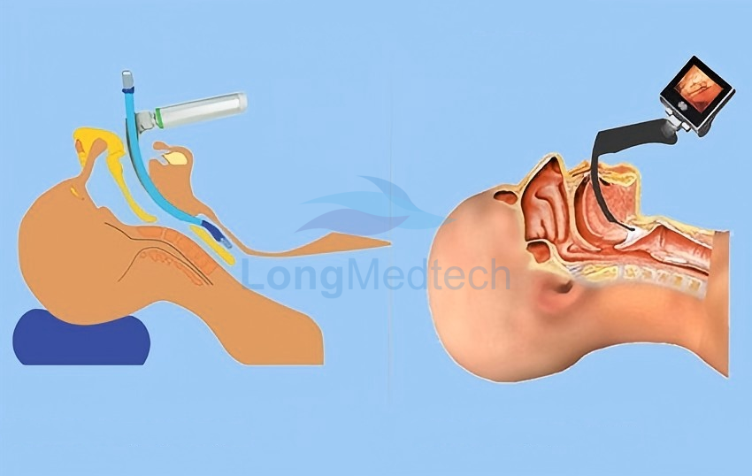 Why Video Laryngoscopes Matter