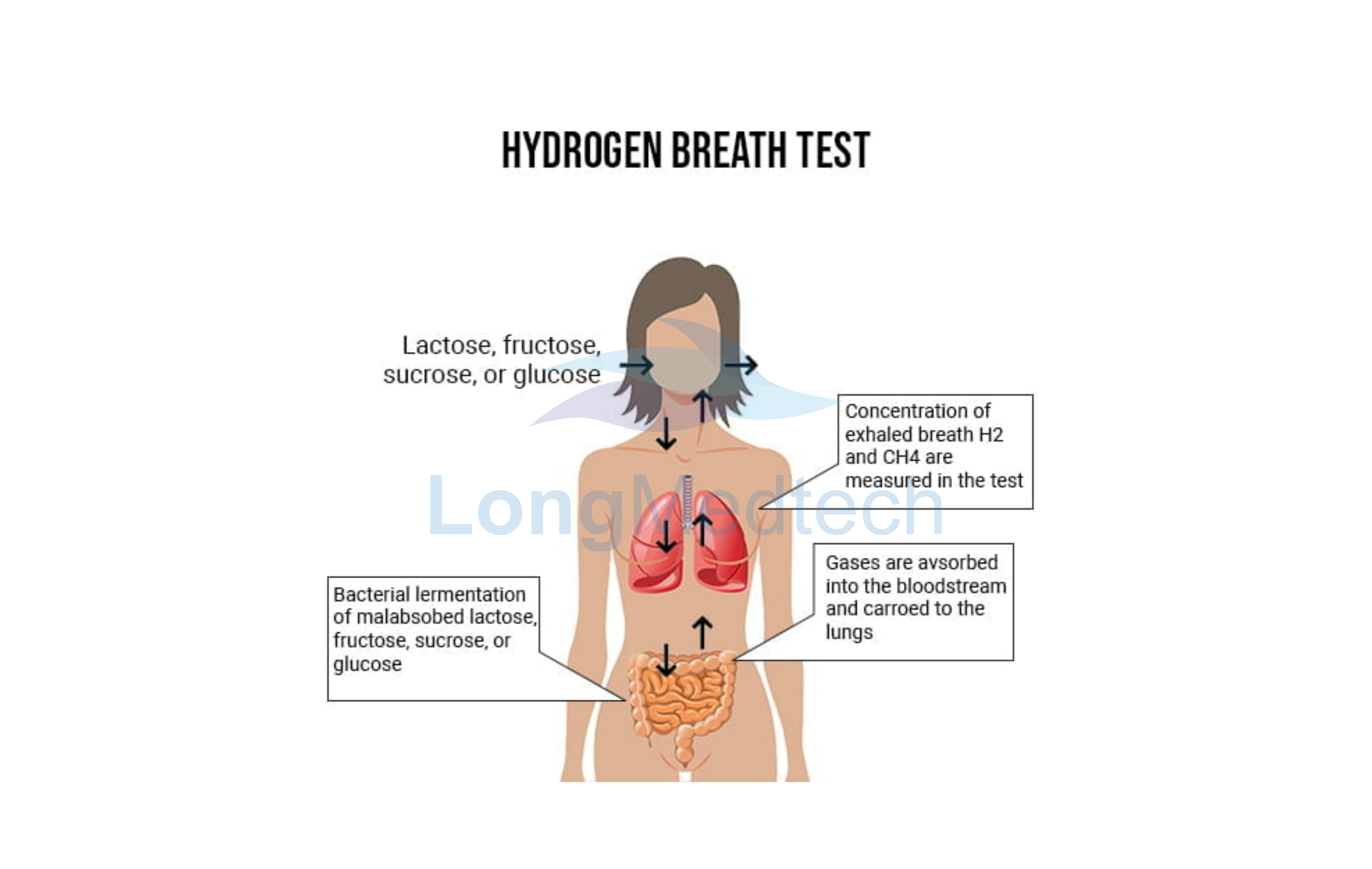 What to Expect During an H2 Breath Test