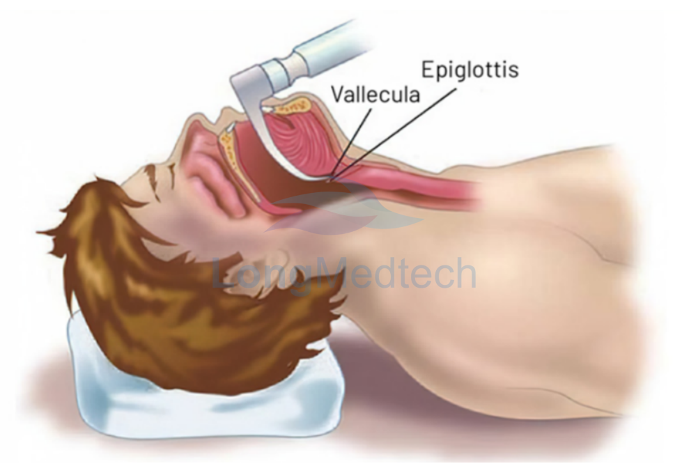 What Is A Video Laryngoscope